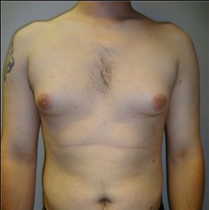 manhattan gynecomastia surgery before 5